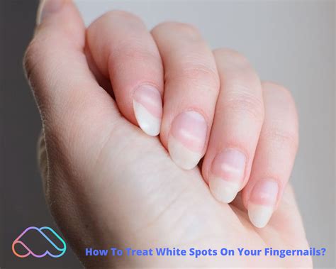 What Causes White Spots on Nails and How to Treat Them .